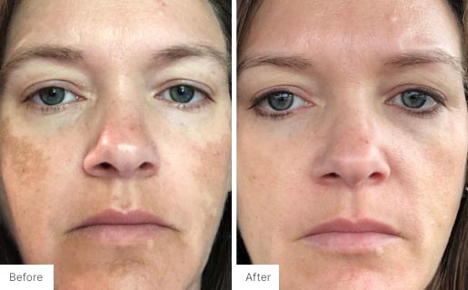 6 - Before and After Real Results photo of a woman's face.
