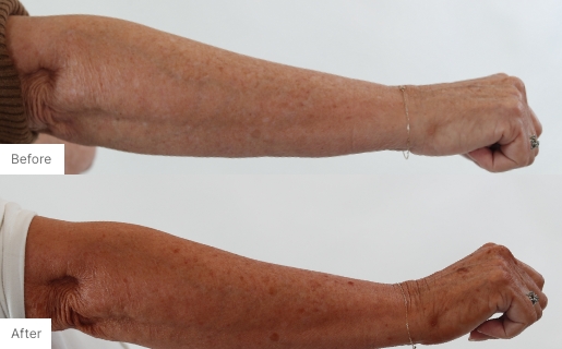 10 - Before and After Real Results of woman's right arm from using the 3-in-1 Self Tanning + Sculpting Foam.