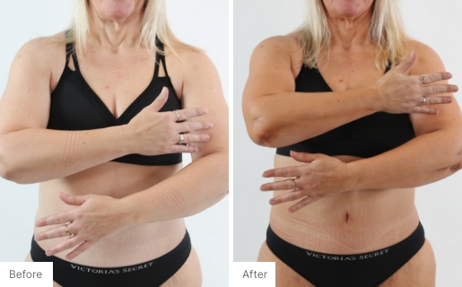 7 - Before and After Real Results of a woman's upper body from using the 3-in-1 Self Tanning + Sculpting Foam.