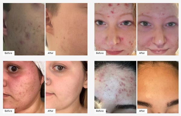 Before and After Real Result images of people using the Clear Complexion Combo.